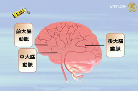 健康大哉問:腦中風