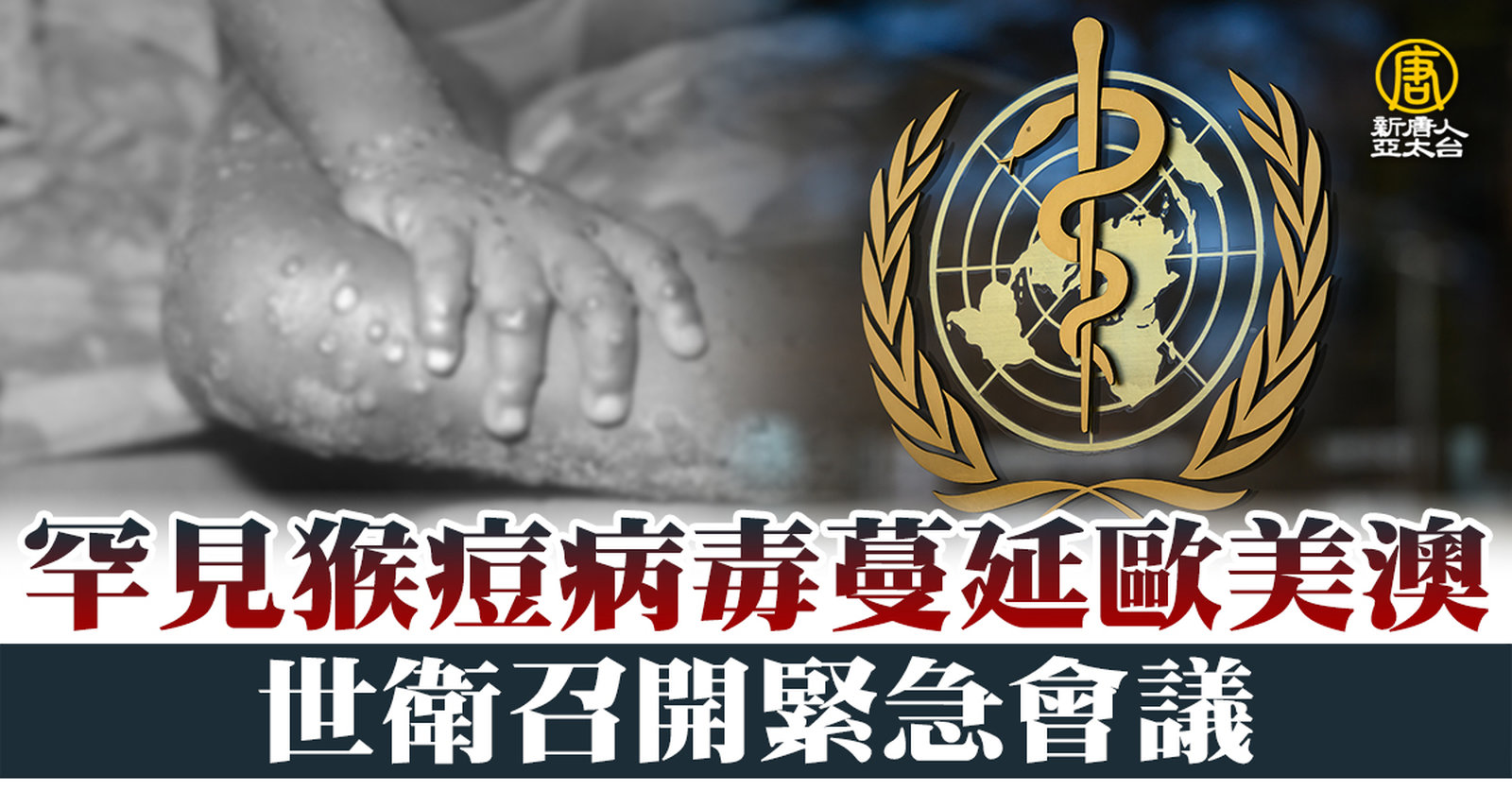 罕見猴痘病毒蔓延歐美澳 世衛召開緊急會議