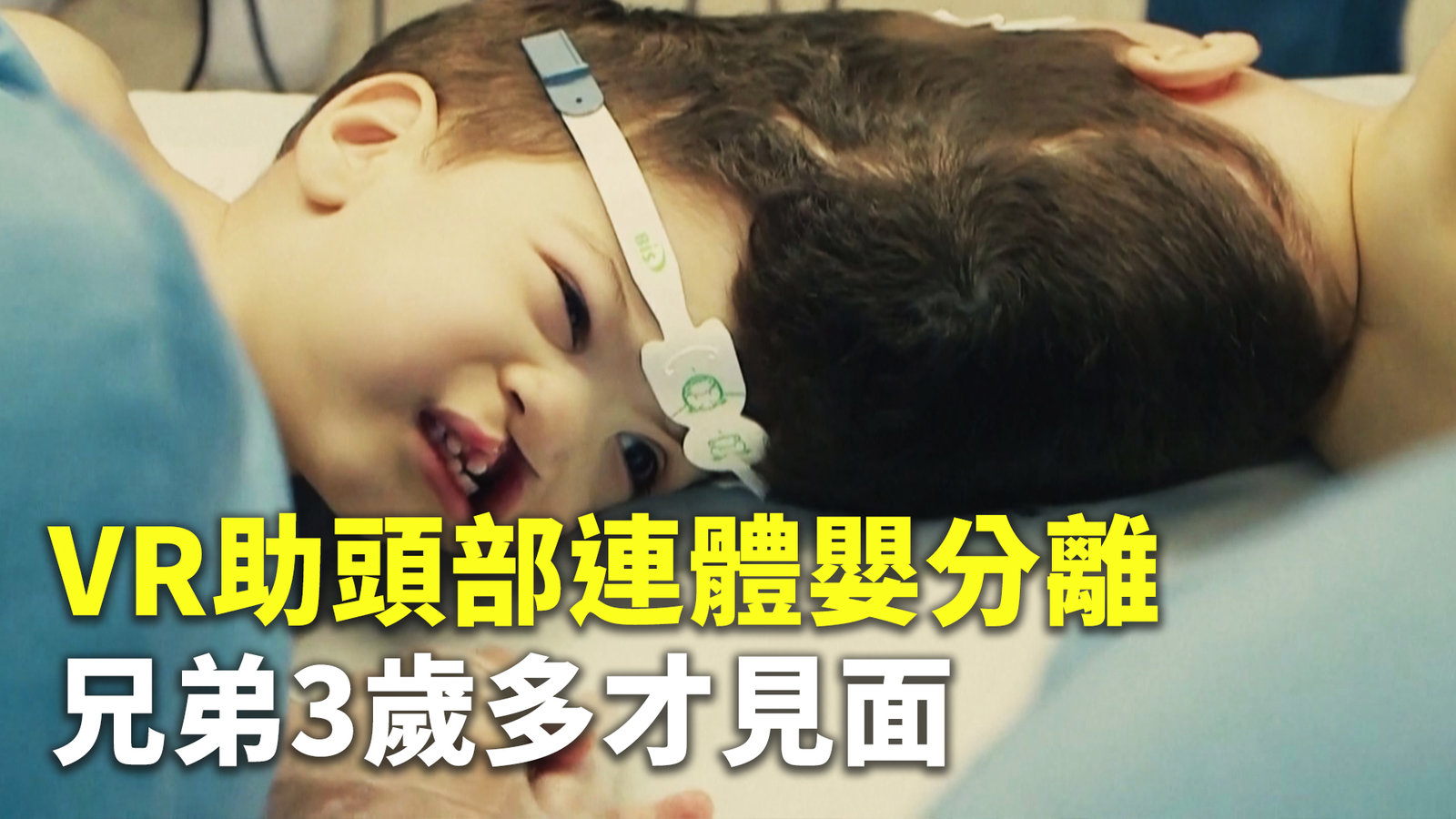 VR助頭部連體嬰分離 兄弟3歲多才見面
