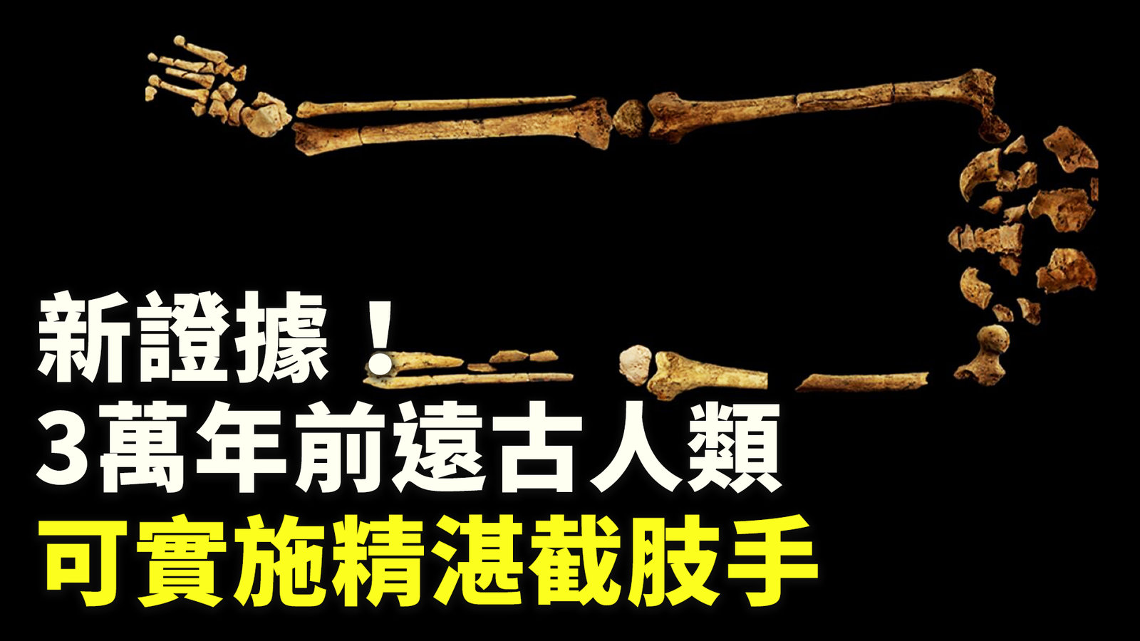 新證據!3萬年前遠古人類可實施精湛截肢手術