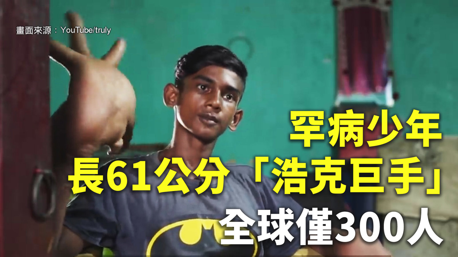 罕病少年長61公分「浩克巨手」 全球僅300人