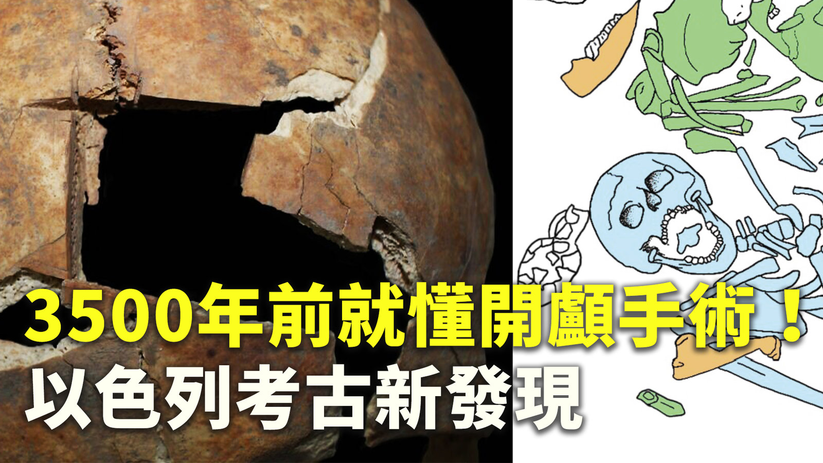 3500年前就懂開顱手術!以色列考古新發現