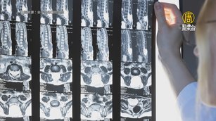 遠離骨質疏鬆中西醫共同照護 降低骨折風險