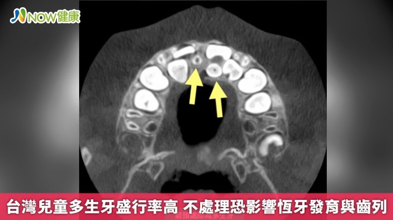 台灣兒童多生牙盛行率高 不處理恐影響恆牙發育與齒列(首圖來源/奇美醫院提供)