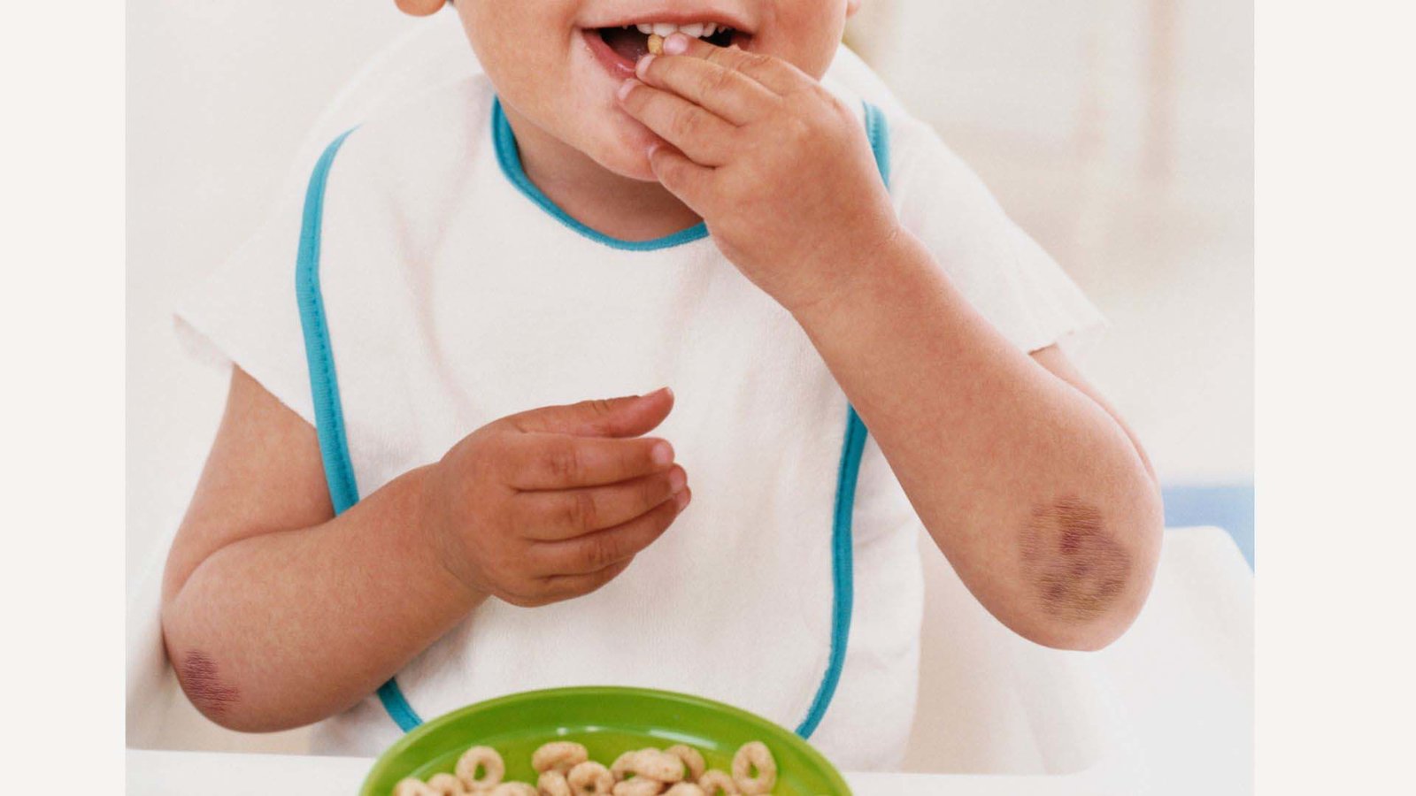 小孩身上若經常出現不明瘀青或關節腫痛,應及早就醫檢查。(嘉基提供)