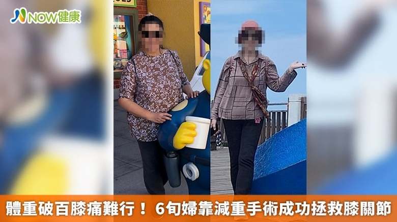 體重破百膝痛難行!6旬婦靠減重手術成功拯救膝關節(首圖來源/亞東醫院提供)