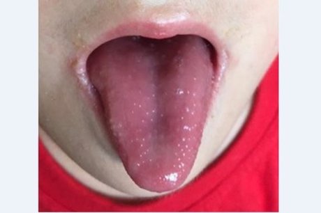 A型鏈球菌咽喉炎秋冬好發傳染力強 新唐人亞太電視台