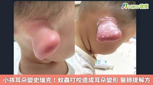 有網友在粉絲團分享，自己的小孩不知為何耳朵腫到完全變形，有如史瑞克的耳朵。（圖／截取自FB粉絲團）