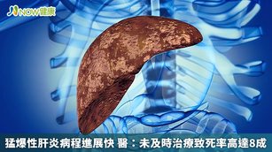 猛爆性肝炎病程進展快速，未及時治療致死率高達8成，近日合庫金董事長林謙浩就因猛爆性肝炎突然發作，入院治療仍回天乏術，因此台灣肝病醫療策進會提醒，民眾若出現黃疸症狀，應儘快就醫，以免憾事發生。（圖／NOW健康製作；圖片來源／ingimage）