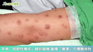 結節性癢疹是一種慢性皮膚疾病，好發於壯年及中老年人，病灶外觀有明顯較大、偏硬的顆粒狀結節，甚至融合成板塊，引發原因多元。（圖／蔡呈芳教授提供）
