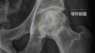 股骨頭缺血性壞死-x光（局部）。（朴子醫院提供）