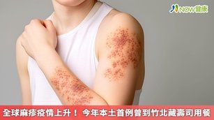 全球麻疹疫情上升！今年本土首例曾到竹北藏壽司用餐(首圖來源／Freepik)