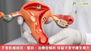 子宮肌瘤成因、警訊、治療全解析 保留子宮守護生育力(首圖來源／Freepik)